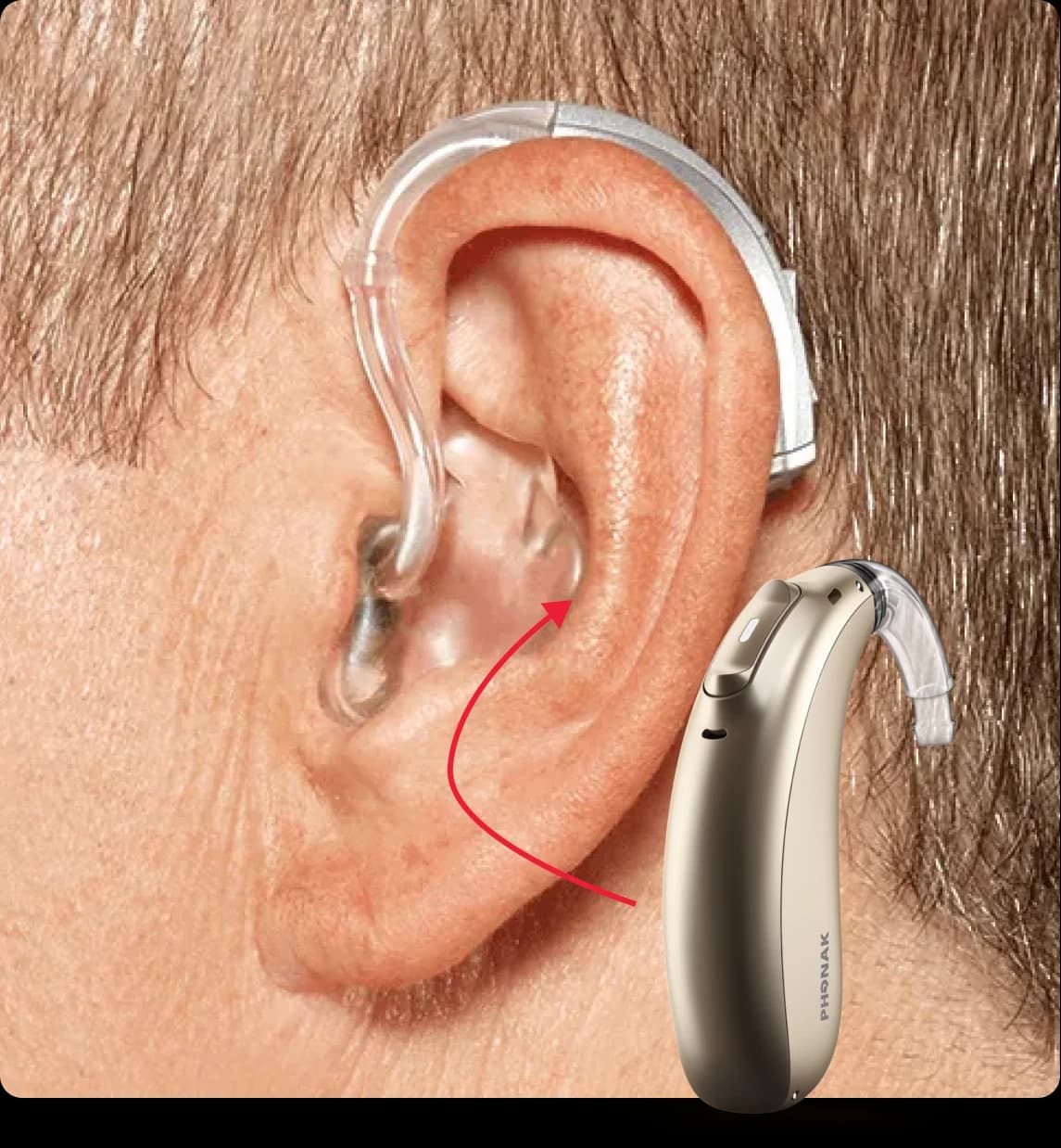 What is a BTE Hearing Aid?