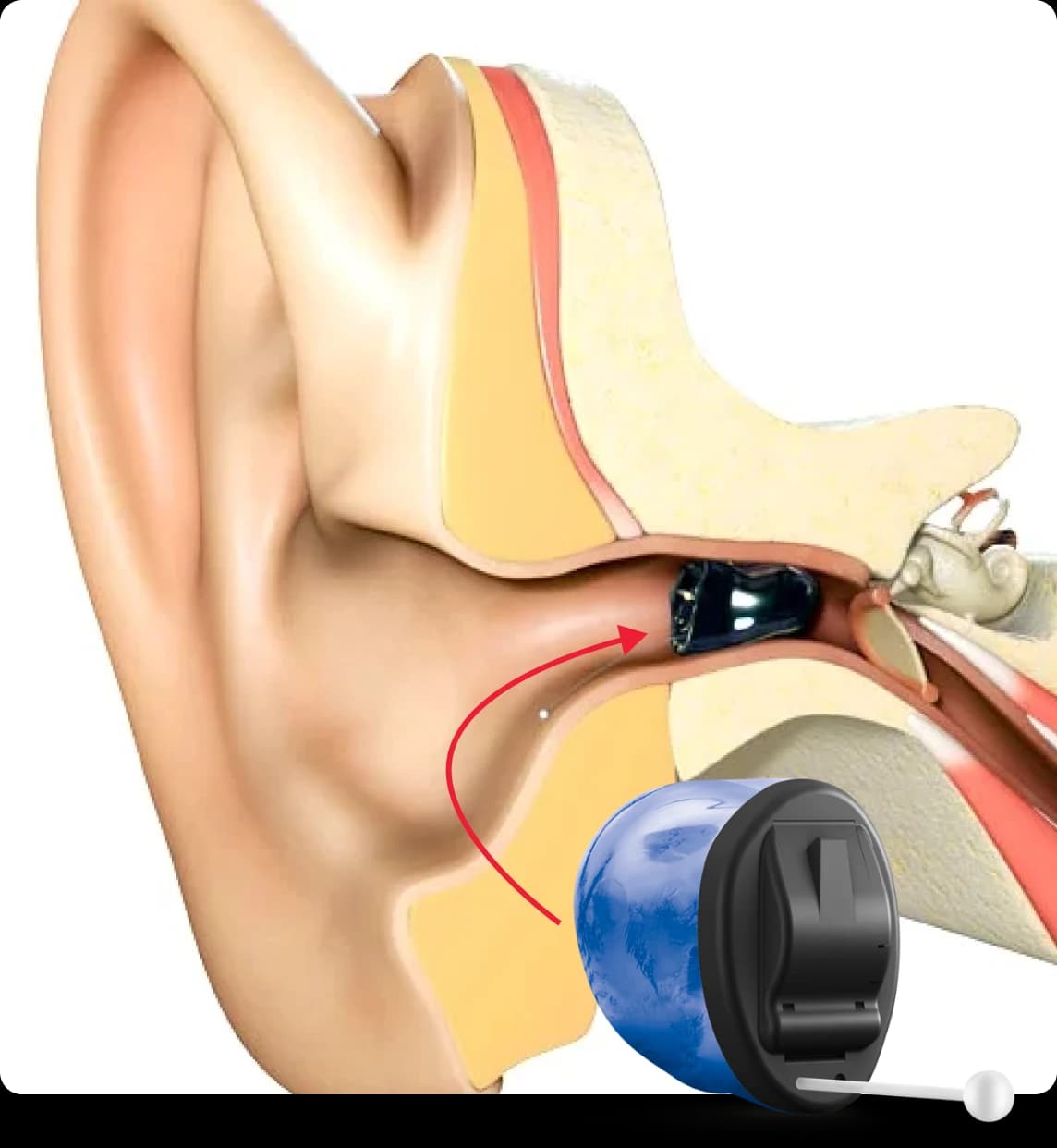 What is a IIC Hearing Aid?