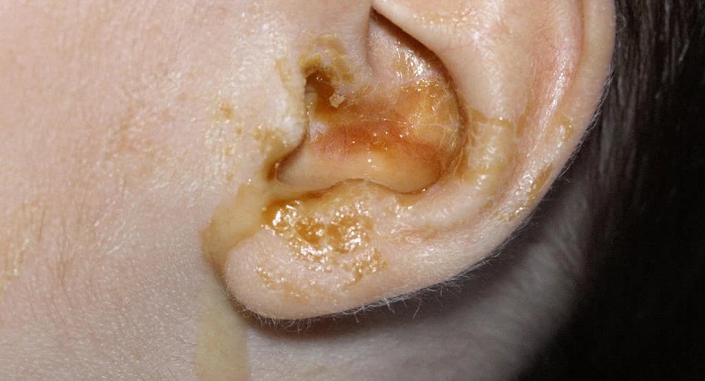 Glue Ear: A Common Yet Overlooked Issue