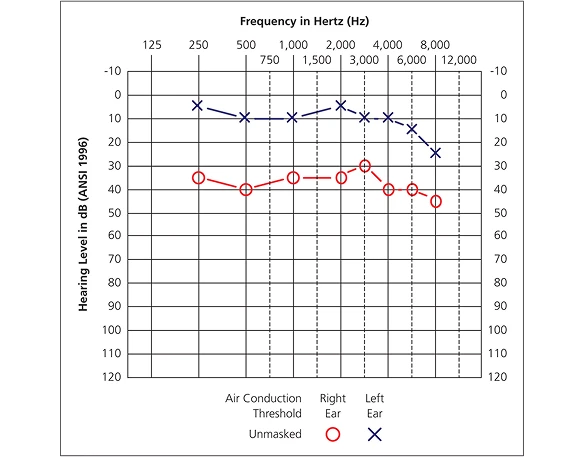 What Mild Hearing Loss Feels Like in Real Life