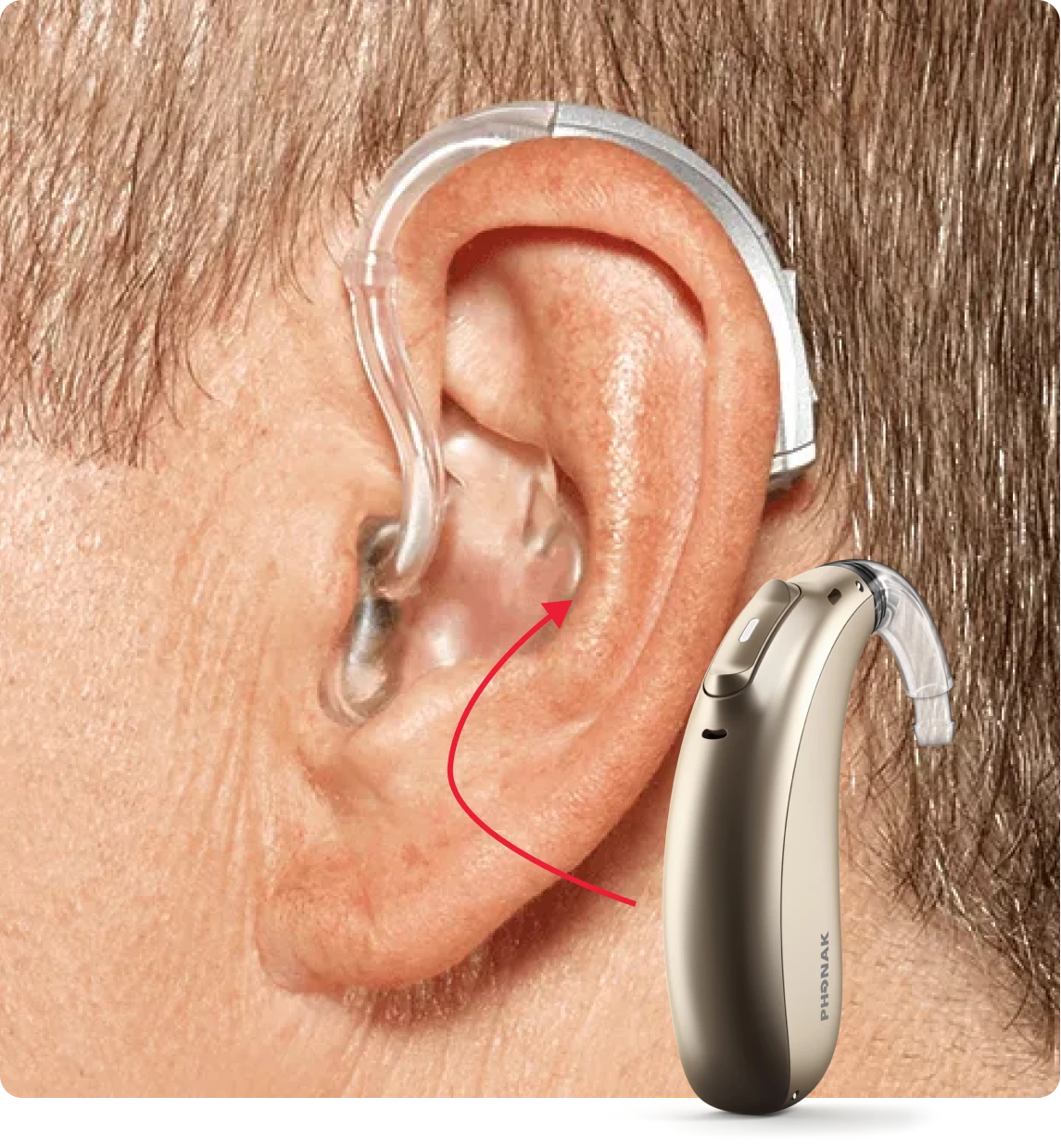 What is a BTE Hearing Aid?